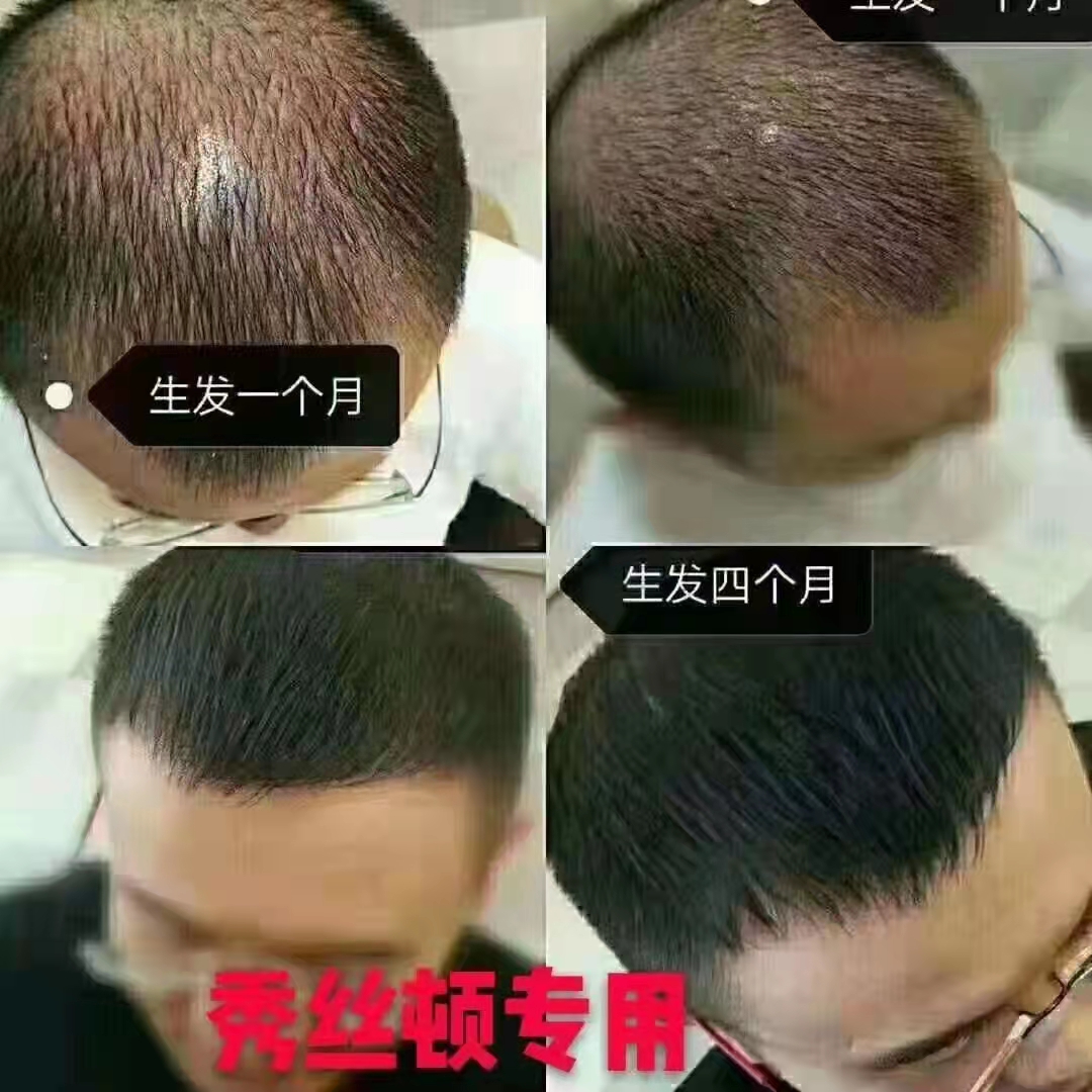 脂溢性脱发特点